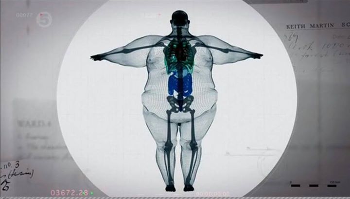 Skeleton of the man of 400 pounds